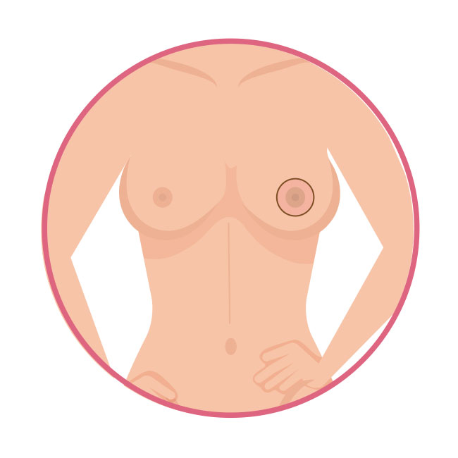 alteraciones pezon cuima